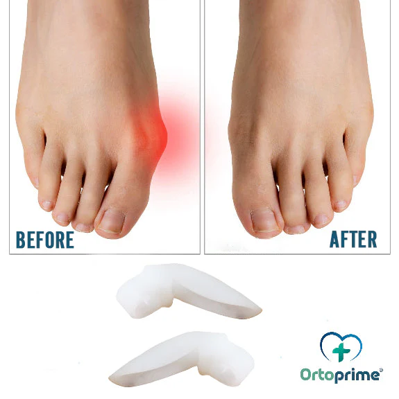 Zehentrenner-Set zur Korrektur von Hallux Valgus | 2 Stücke - Image 3